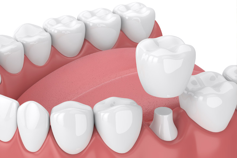 Dental Crowns in Indianapolis