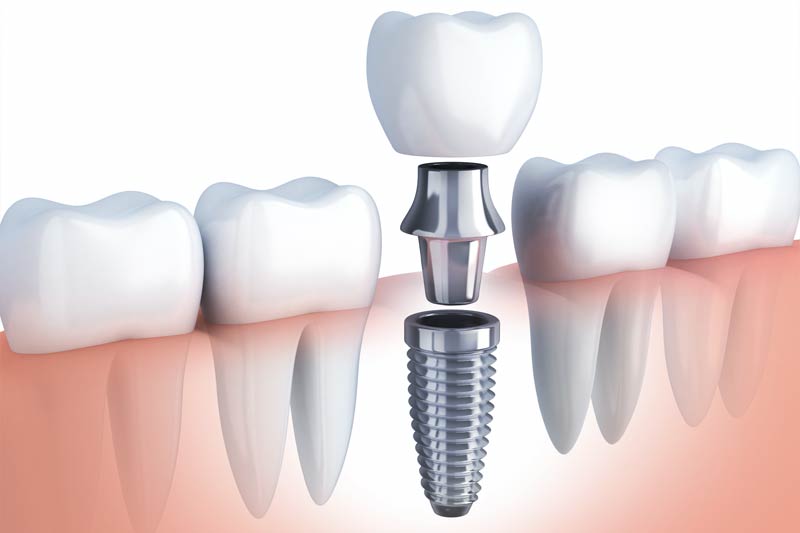 Implants Dentist in Indianapolis