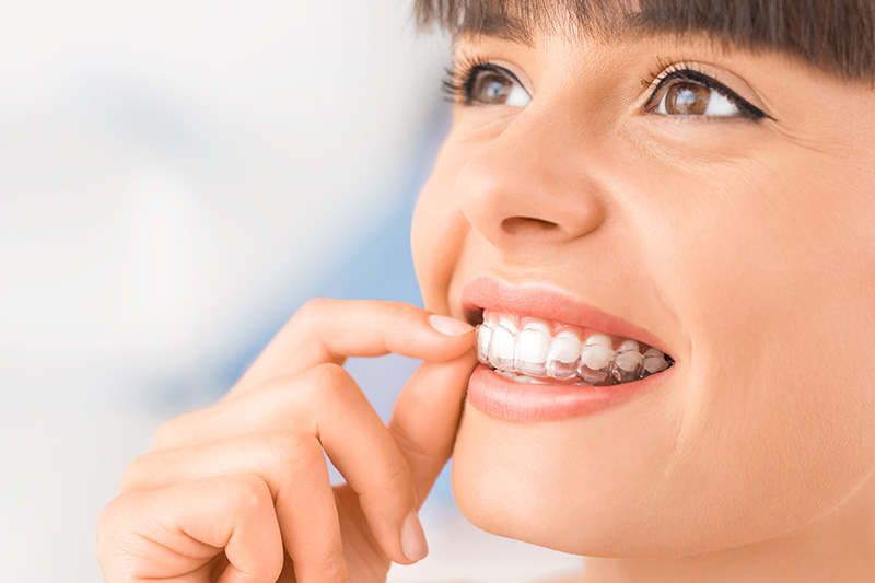 Clear Aligner Treatment in Indianapolis