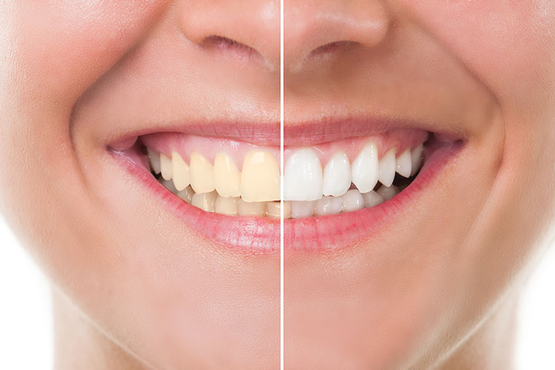 Teeth Whitening in Indianapolis
