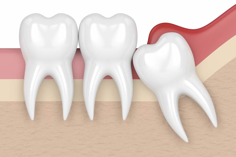 Wisdom Tooth Removal in Indianapolis